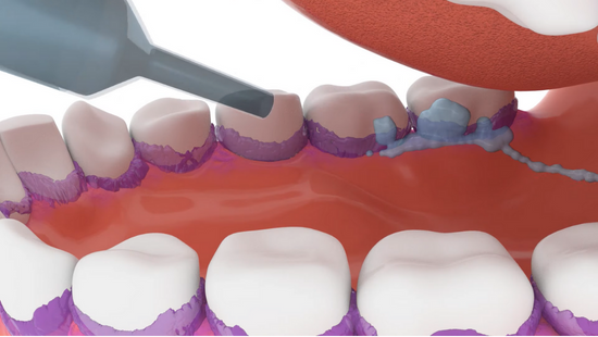 VAP: Ventilator-assoziierte Pneumonie, Entwicklung und Prävention 